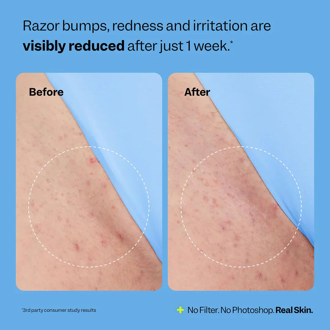 Smoothing Solution Ingrown Hair Treatment: Glide Your Way to Silky-Smooth, Bump-Free Skin